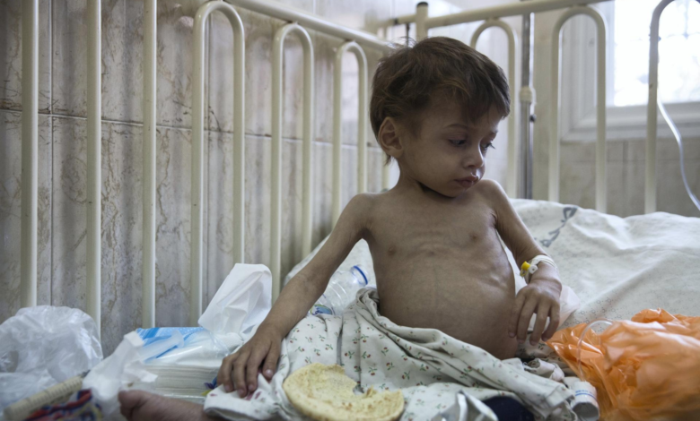 أونروا: 66 ألف طفل في قطاع غزة يعانون سوء تغذية خطيرا. اطفال غزة